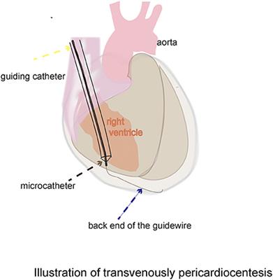 Novel dry pericardiocentesis: Transvenous puncture of the right ventricle with the back end of a 0.014-inch PTCA guidewire and a 1.8 Fr microcatheter